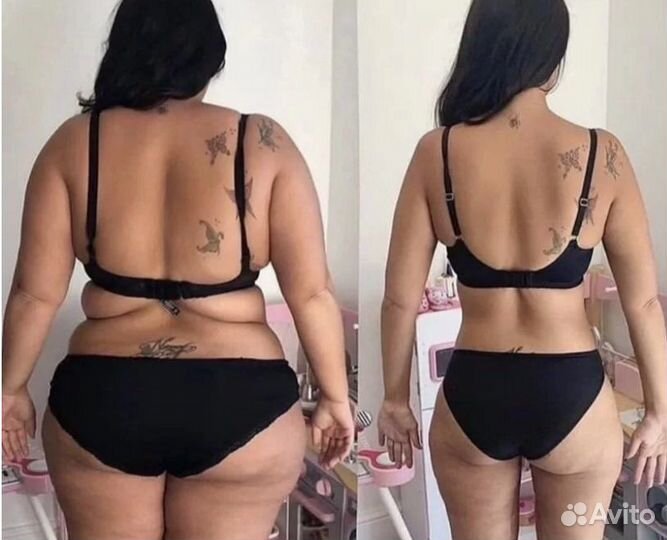 Сжигание жира без диет. Криолиполиз