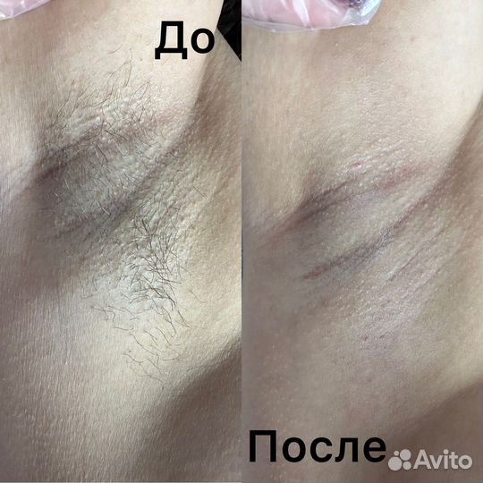 Депиляция