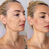 Ботокс Full Face, Видное