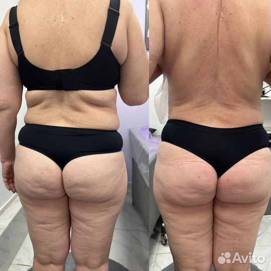 Аппаратная коррекция фигуры