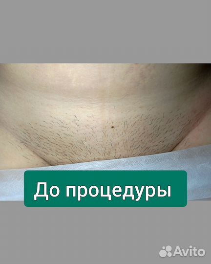 Мастер электроэпиляции
