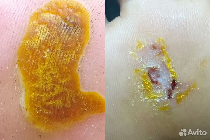 Удаление бородавок СПб