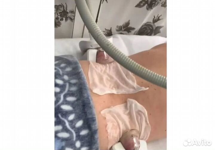 Плоский живот - размер за 1 процедуру в Казани