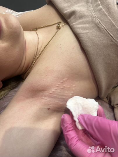 Ботокс лица, биоревитализвция, мезотерапия