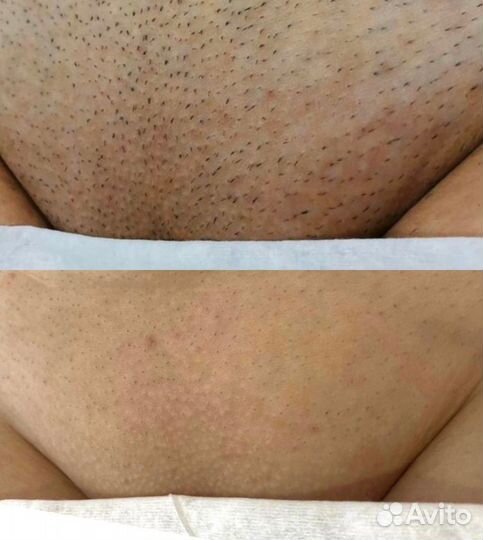 Лазерная эпиляция в Воронеже