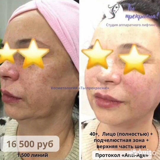 СМАС лифтинг подтяжка лица/ Омоложение/ Косметолог