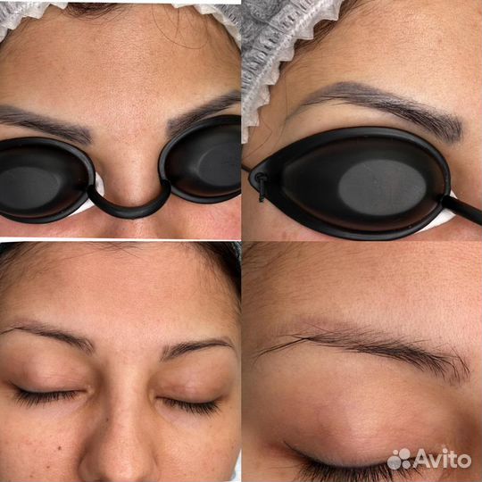 Лазерное удаление татуажа и тату