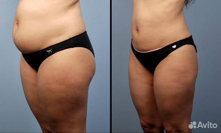 Криолиполиз, коррекция фигуры