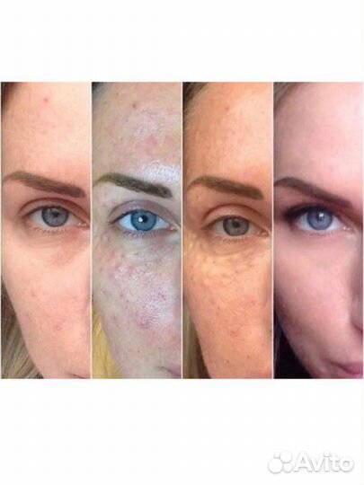 Биоревитализация