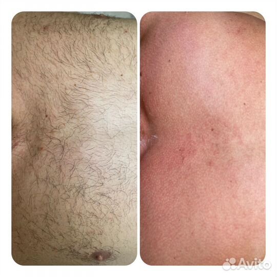 Мужская депиляция, по предоплате