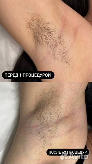 Электроэпиляция
