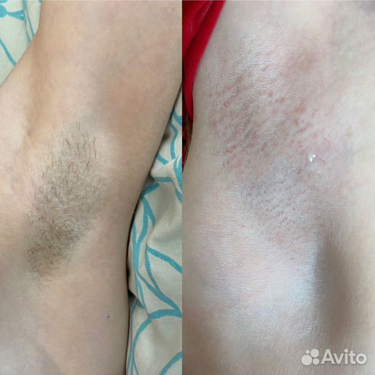 Депиляция воском