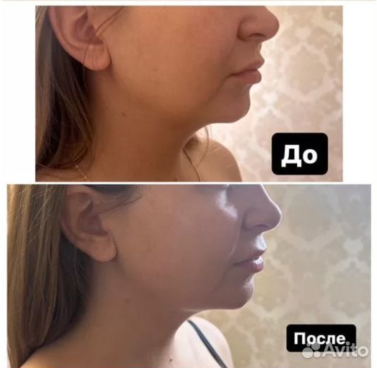 Плоский живот - размер за 1 процедуру