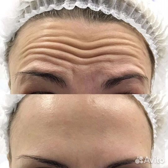 Ботулинотерапия