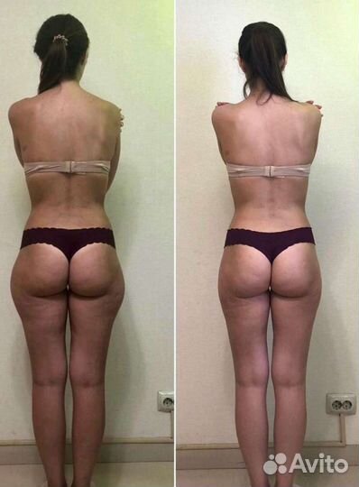 Массаж, ручная липопластика