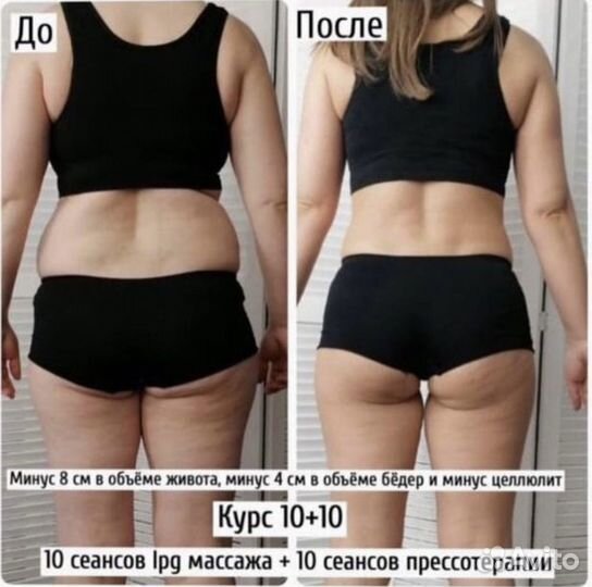 LPG массаж