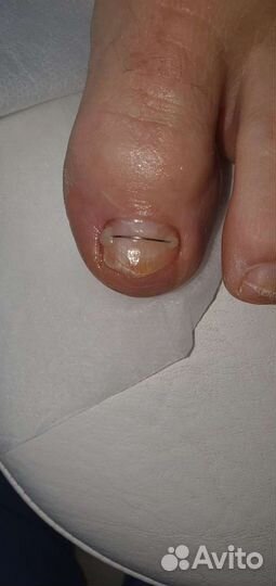 Медицинский педикюр подолог