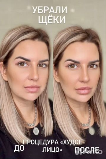 Процедура худое лицо