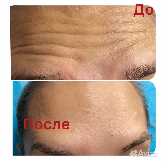 Ботокс для лица