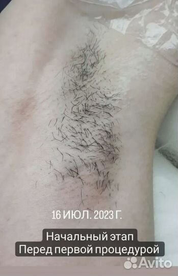 Электроэпиляция модель