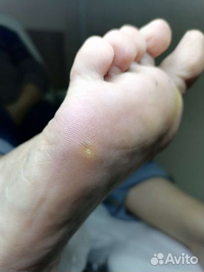 Медицинский педикюр подолог