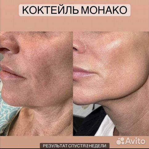 Инъекции ботокса в подмышки