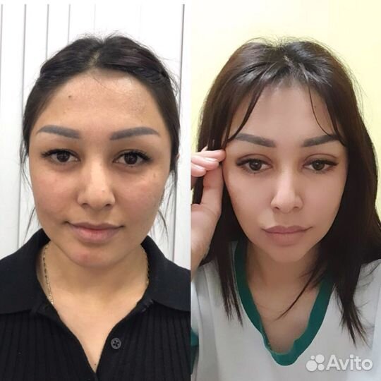 Блефаропластика без разреза