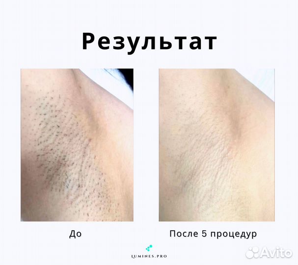 Диодный лазер для эпиляции Лю'Минес Макс Ван 1200в