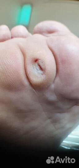 Аппаратный педикюр