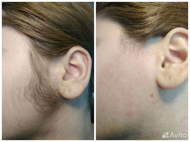 Электроэпиляция