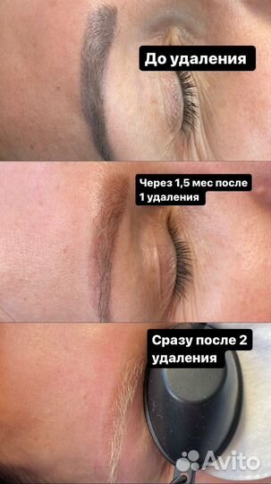 Удаление тату
