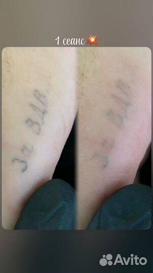 Удаление тату и татуажа