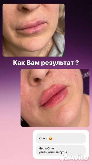 Модель на Увеличение губ