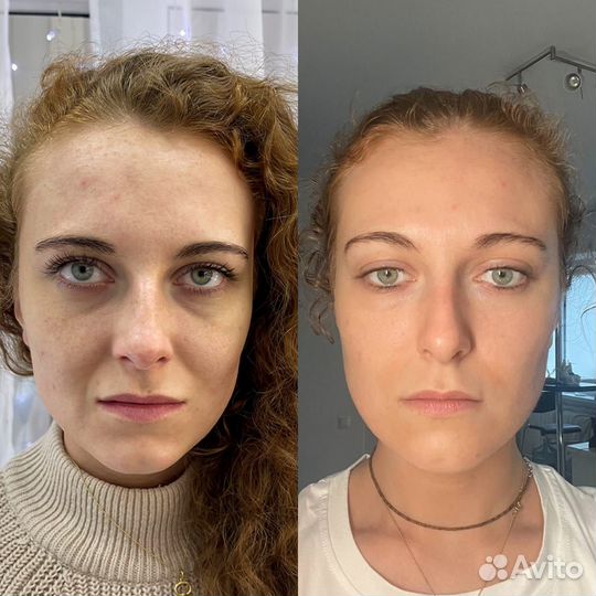 Услуги косметолога / Холодная плазма