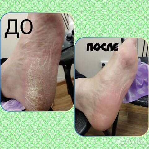 Аппаратный педикюр