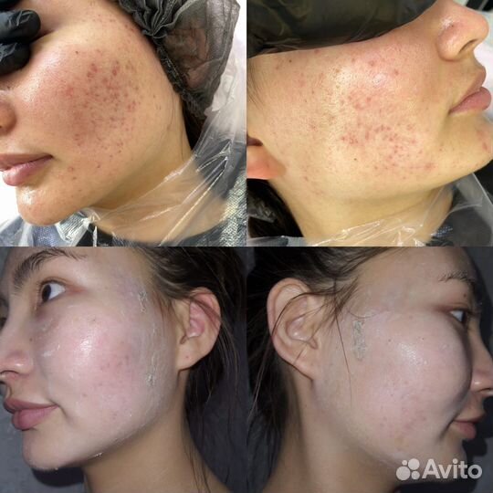 Обучение акне / постакне / коррекция рубцов