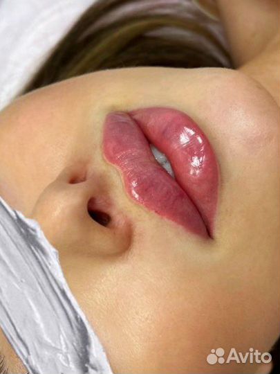 Увеличение губ,углы Джоли, биоревитализация,ботокс