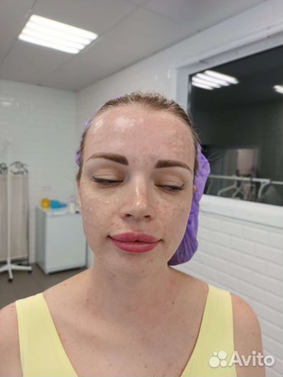 Биоревитализация