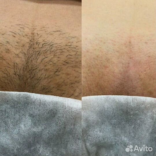 Депиляция Бутово