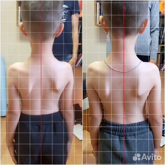 Массаж. Коррекция сколиотической осанки