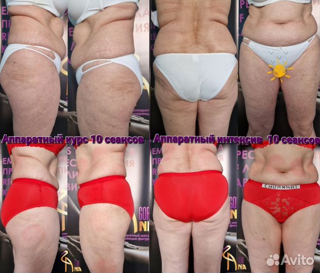 Антицеллюлитный курс, аппаратный массаж