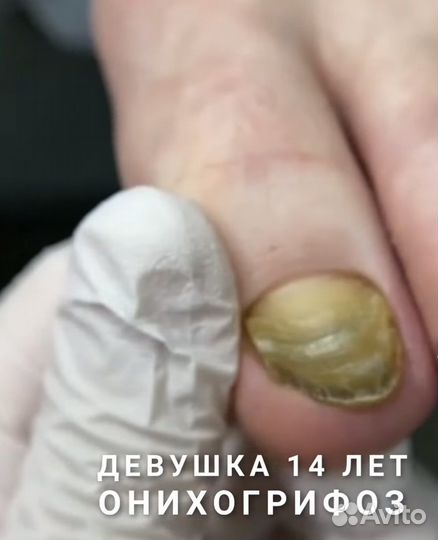 Услуги подолога- коррекция вросших ногтей