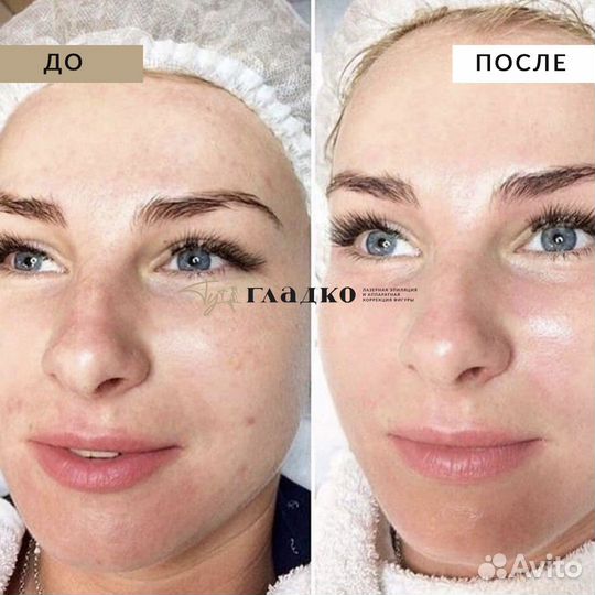 Карбоновый пилинг