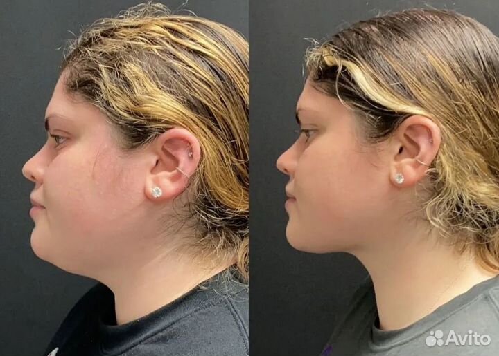 Супер омоложение и подтяжка лица без уколов