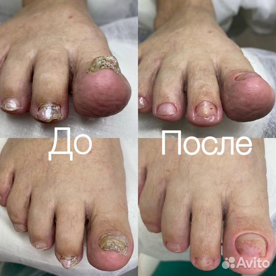 Стрежневая мозоль, Медицинский педикюр, Подолог