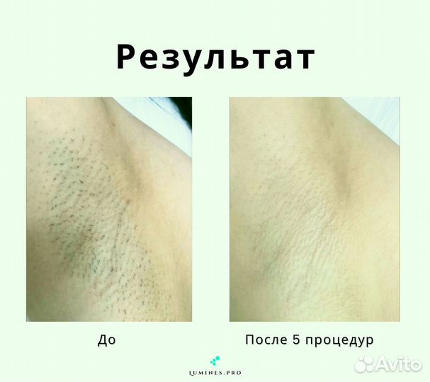 Диодный лазер «Lumines» Макс’Ван 1200в