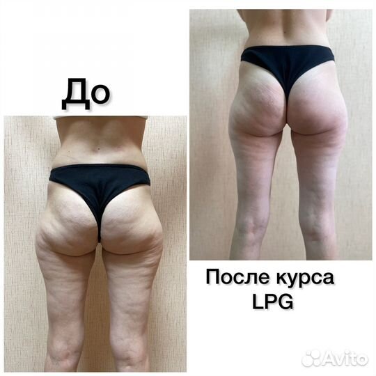 Массаж LPG оригинальный Французский