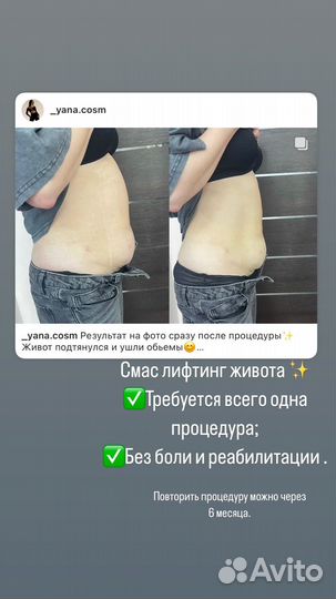 СМАС лифтинг подтяжка лица