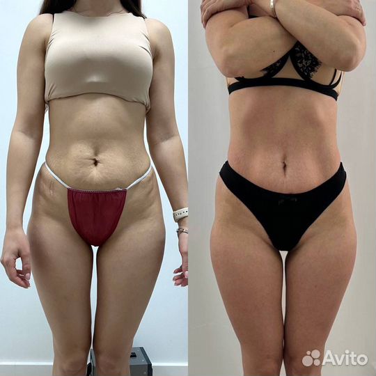 Аппаратный массаж RSL скульптурирование