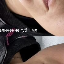Увеличение губ, Майкоп